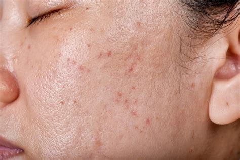 How To Treat And Help Prevent Acne Bumps Under Your Skin
