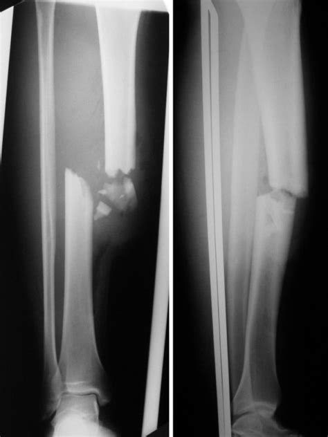 Anteroposterior And Lateral X Ray The Open Shaft Comminuted Tibial