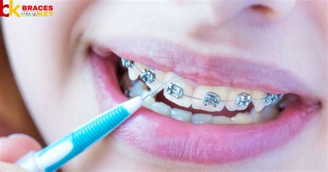 How To Stop Braces Wire From Poking Without Wax Braces Key