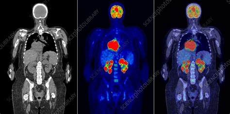 Diffuse Large B Cell Lymphoma Ct And Pet Scans Stock Image C058