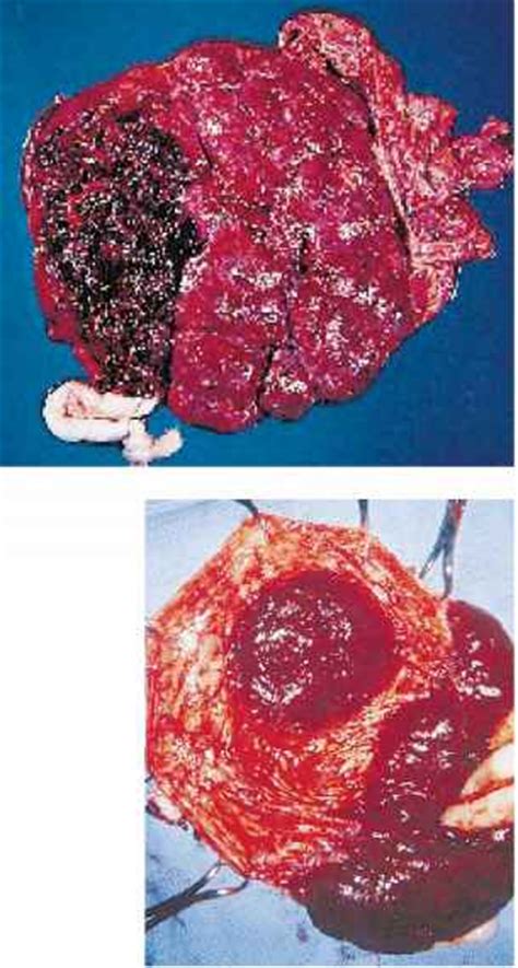 Saha s., biswas s., mitra d., adhikari a., saha c. The Placenta Its Membranes and the Umbilical Cord - Newborns