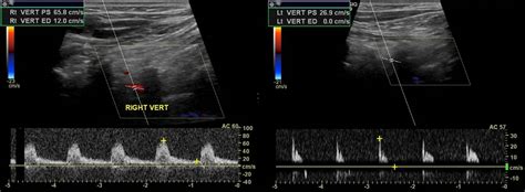 Vertebral Artery Stenosis Ultrasound