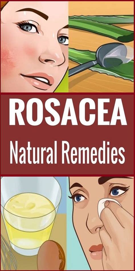 Home Remedies For Rosacea That Might Help You Home Remedies For