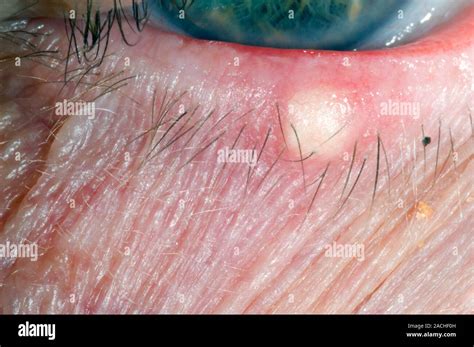 Close Up Of The Lower Eyelid In A Year Old Male Patient Showing A