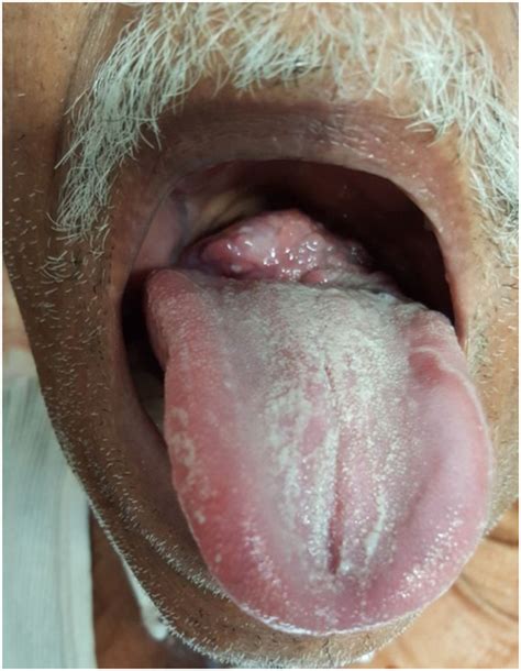 Showing The Mass At The Base Of Tongue As Indicated By The Black Arrow