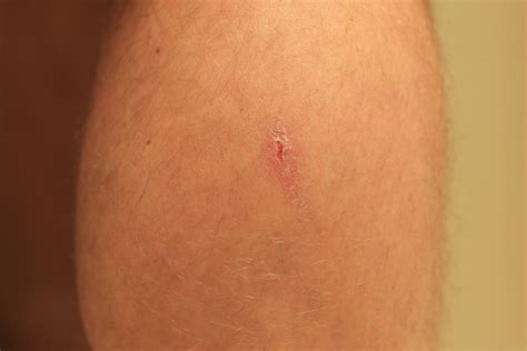 How To Get Rid Of Leg Scars Caused By Picking At Scabs Healthfully