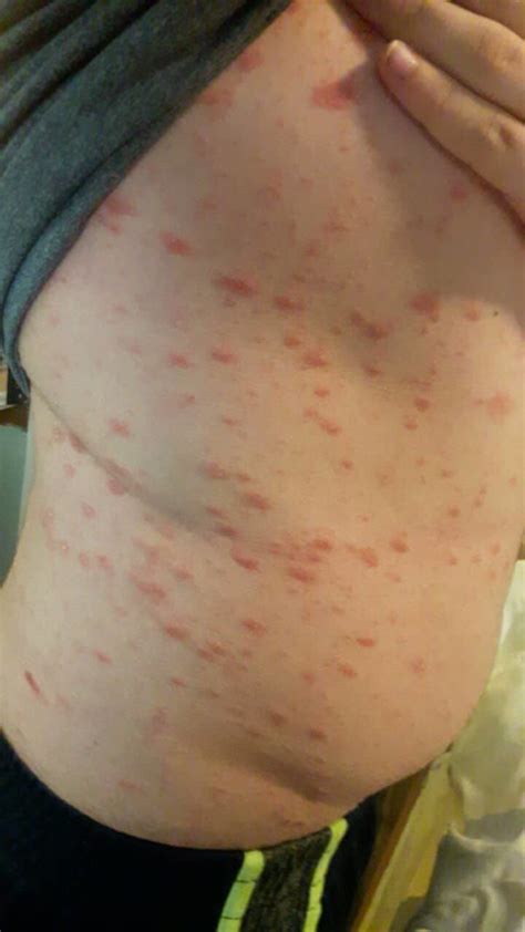 My Son Has This Rash For 2 Weeks Now Its Everywhere And Itchy Ask A
