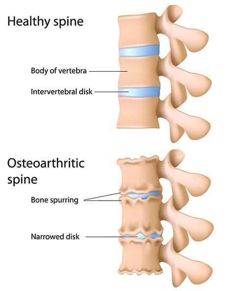 Lower Back Arthritis Spinal And Sports Care Parramatta Castle Hill And Wetherill Park