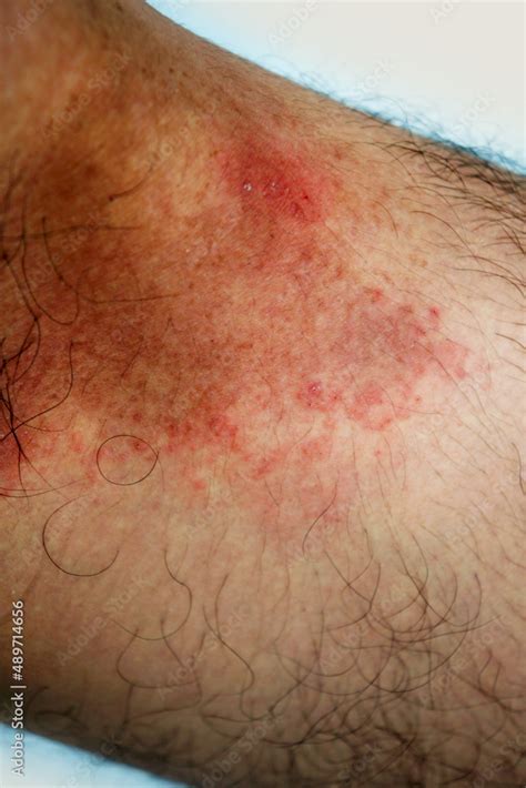 Itchy Rash In The Groin Area Tinea Cruris Is A Type Of Skin Disease That Occurs In The Groin