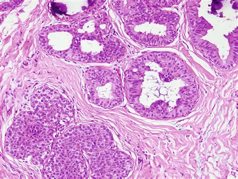 Intraductal Proliferative Lesions Basicmedical Key