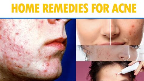 10 Home Remedies For Acne Youtube