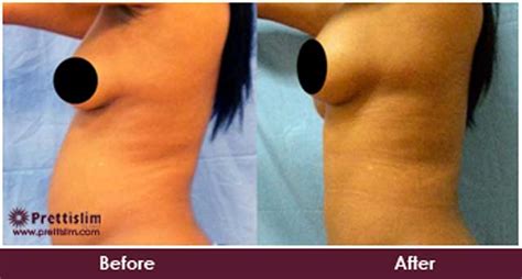 Relax your eyes for a few seconds. Non Surgical Sagging Asymmetrical Breast Lift Treatment ...