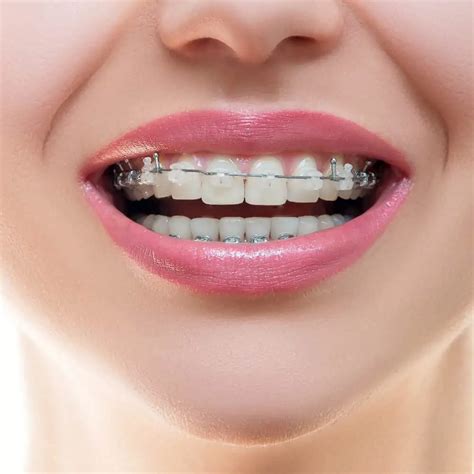 Clear Braces Guide Information On Types And Costs In The Uk