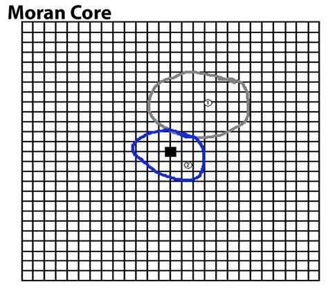 Moran Core Central Serous Chorioretinopathy Case Report