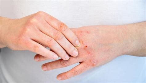 What Do You Need To Know About Psoriasis On Hands And Feet Human