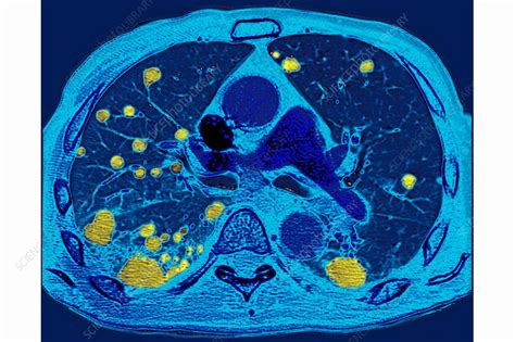 Lung Metastases Ct Scan Stock Image C0306799 Science Photo Library