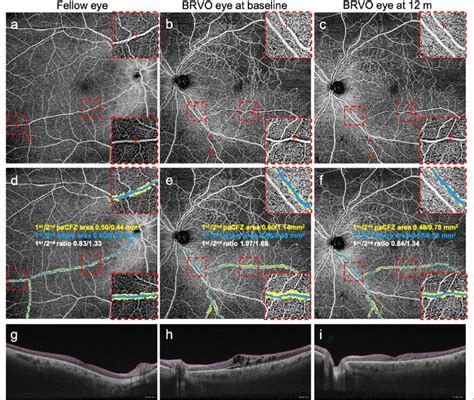 Representative Swept Source Optical Coherence Tomography Angiography