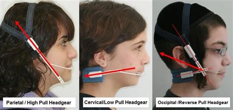 Uses Of Orthodontic Headgear With Braces Headgear Braces
