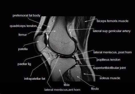 Mri Anatomy Of The Knee Knee Mri Knee Anatomy Mri