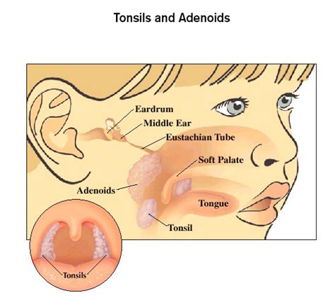 Tonsil And Adenoid Conditions Brigham And Womens Faulkner Hospital