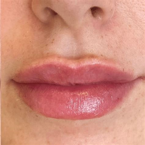 Is It Normal To Have Lumps After Lip Filler Lip Filler Side Effects
