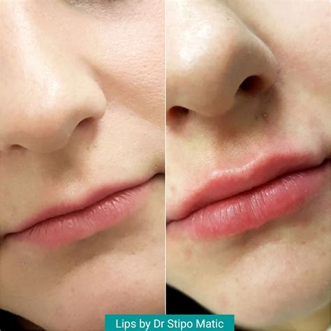 Lip Fillers Maticlinic Aesthetics ǀ Anti Wrinkle Injections ǀ Dermal Fillers