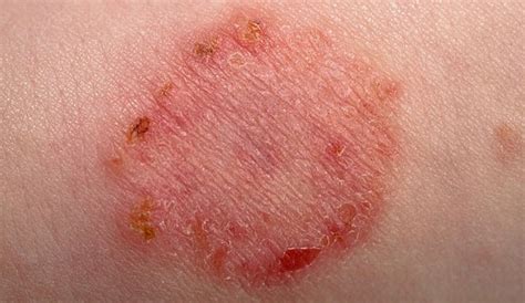 In most people, a red itchy rash around the groin is a common sign of skin infection. Rashes in babies and children | NHS.UK