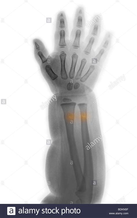 X Ray Of The Forearm Of An Infant Showing A Greenstick