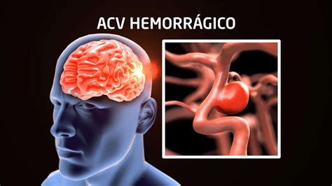 Enfermedad cerebrovascular hemorrágica qué es y su fisiopatología