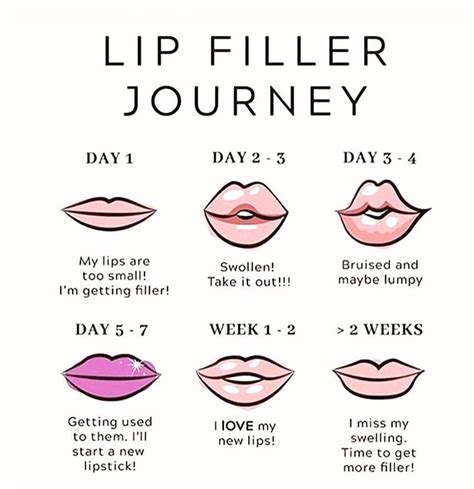 How Long Does Swelling Last After Lip Filler The Daily Glimmer