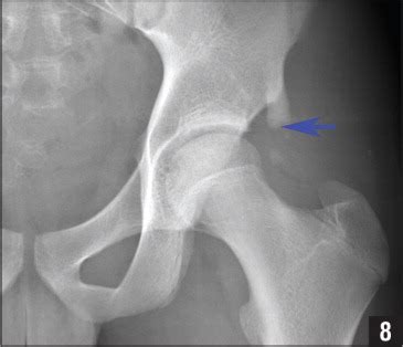 Adolescent Femoroacetabular Impingement From Malunion of ...
