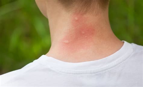 Common Summer Bug Bites When To Seek Dermatology Care In Tn