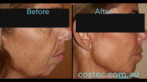 Hifu™ Treatment Before And After Pictures For Face Lift And Skin