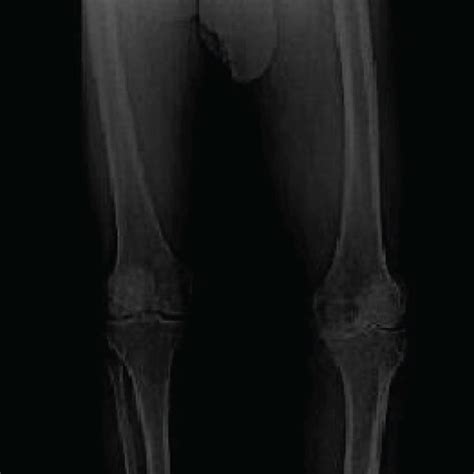 Pdf Total Knee Arthroplasty After Correction Of Tibial Diaphyseal