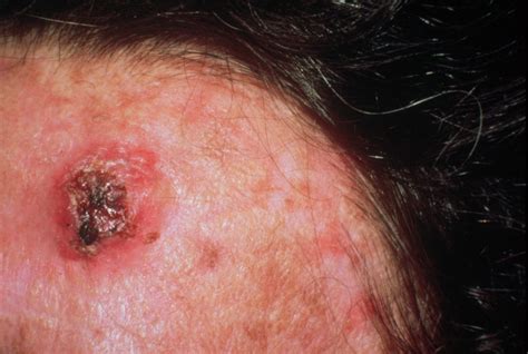 Skin Cancer Types Severity Histoplasmosis Cause Types Vrogue Co