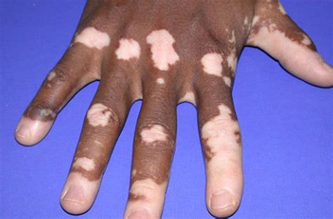 White Leprosy