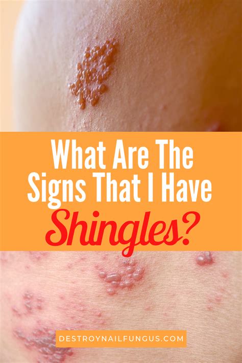 shingles early warning signs