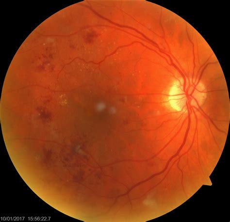 Back To Basics Diabetic Retinopathy Sydney Ophthalmic Specialists