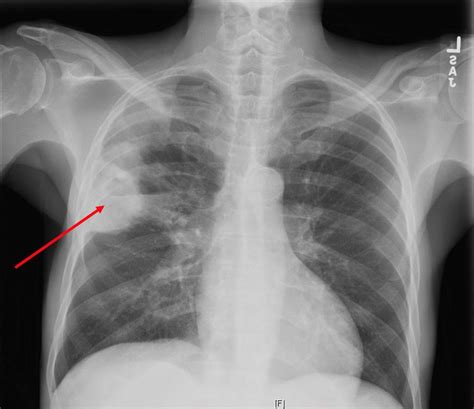 Bronchopneumonia Chest X Ray