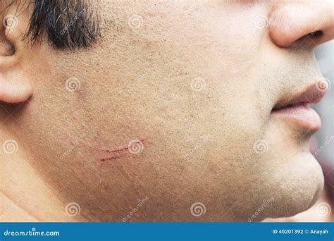 A Cut On Male Cheek With Blood Stock Photo Image Of Recovery Injury