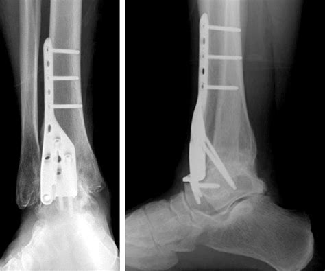 Ankle Fusion Surgery Footcare Friday Alpine Orthopedics And Sports