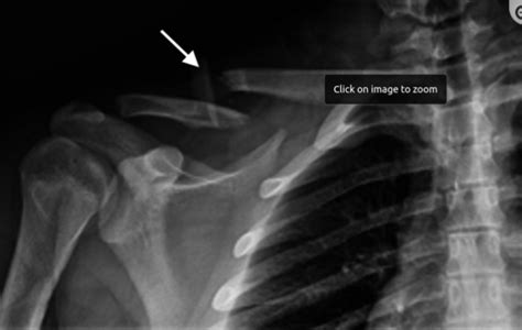 Broken Collarbone Clavicle Fracture Recovery Time And Tips