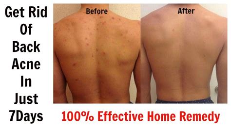 Get Rid Of Back Acne In Just 7 Days 100 Effective Home Remedy