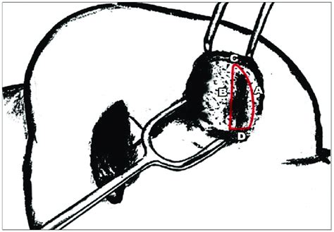 Schematic Illustration Of The Sail Excision Technique A Anterior