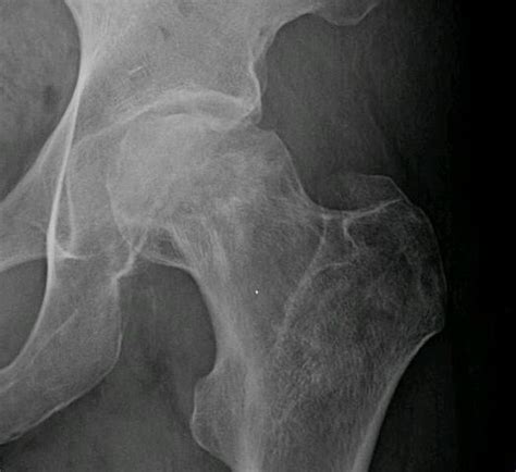 Collapsed Femoral Head