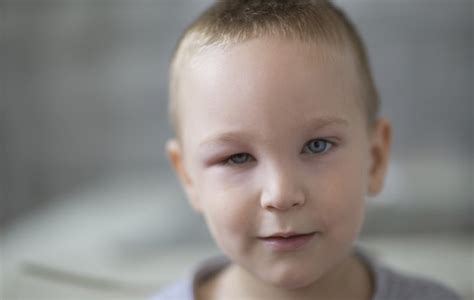 A Swollen Eyelid In A Child