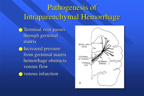 Ppt Intraventricular Hemorrhage Powerpoint Presentation Free