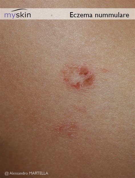 Dermatite Atopica Terapia Macchia Rossa Sulla Pelle Circolare