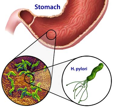 H Pylori Infection Symptoms Causes Risk Factors Complications