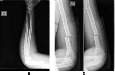 A B Another Patient With A Distal Diaphysis Humeral Fracture And